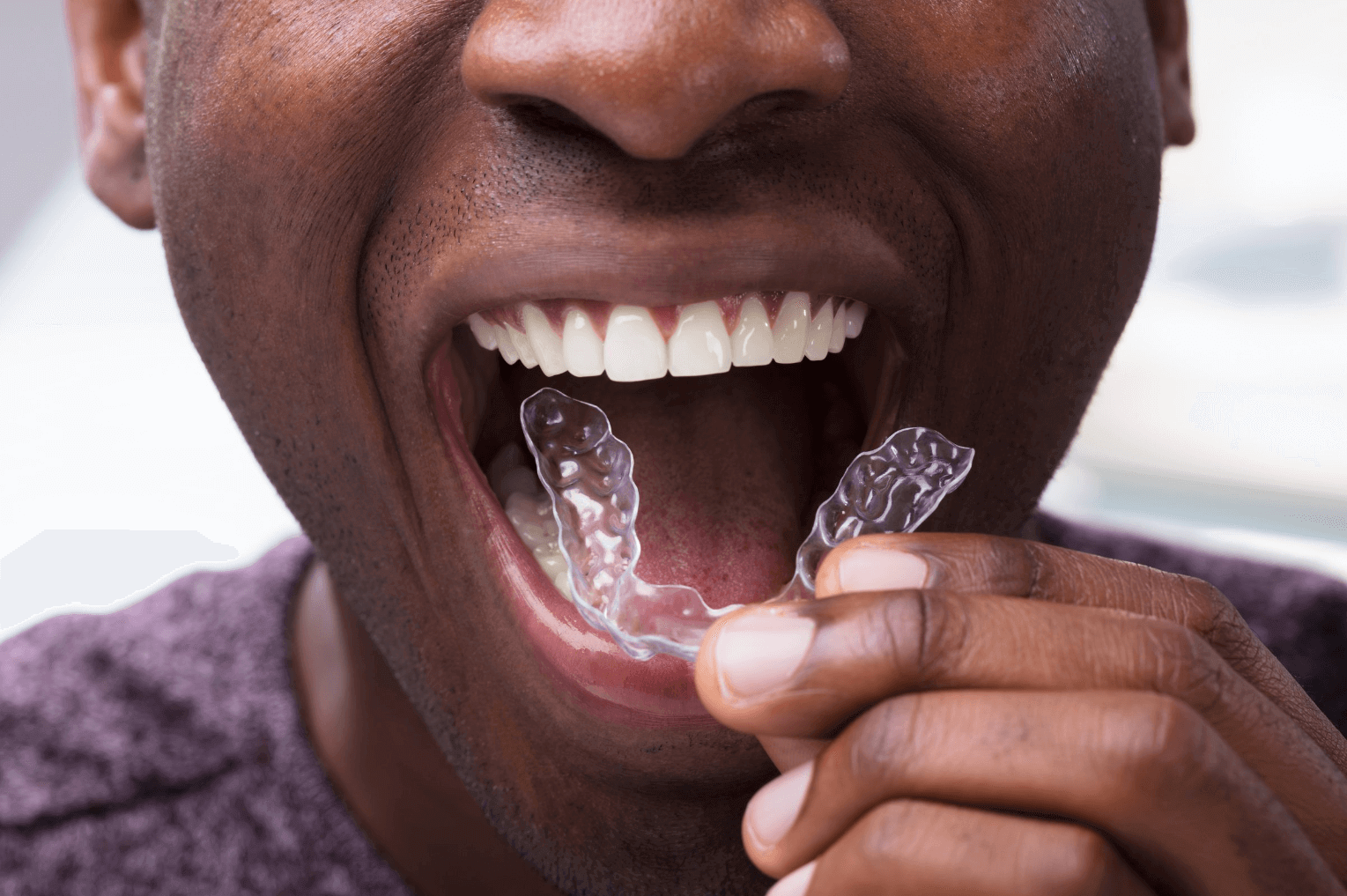 man with straight white teeth taking out his Invisalign braces from his mouth