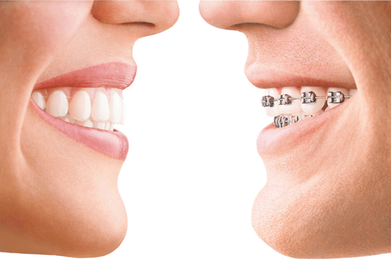 woman with invisalign and a man with metal braces, london