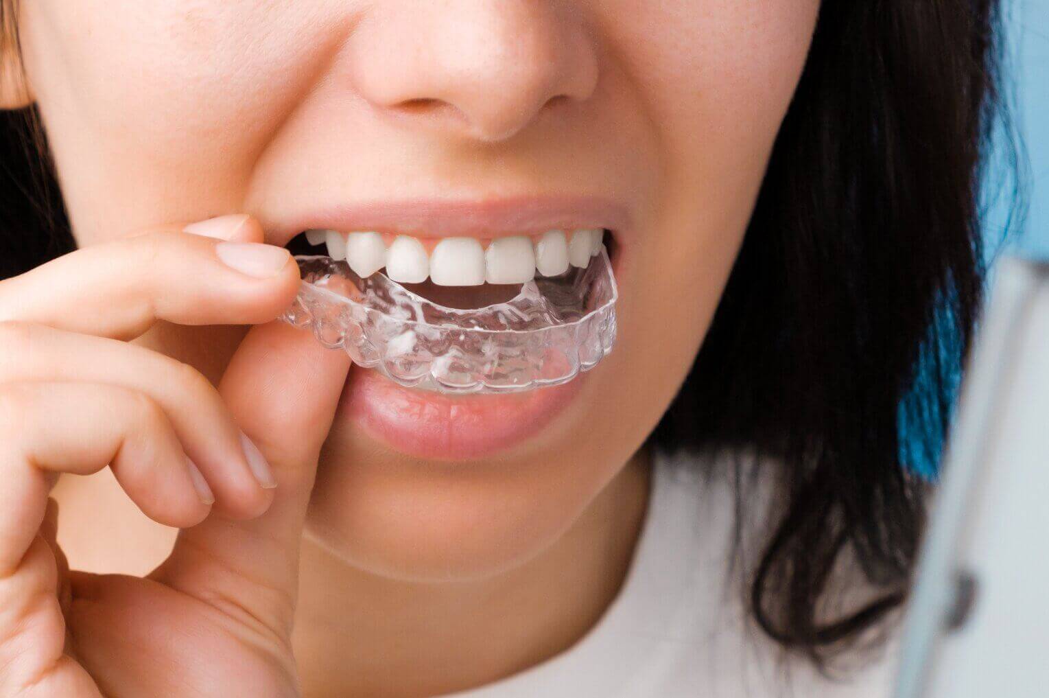 woman putting in invisalign