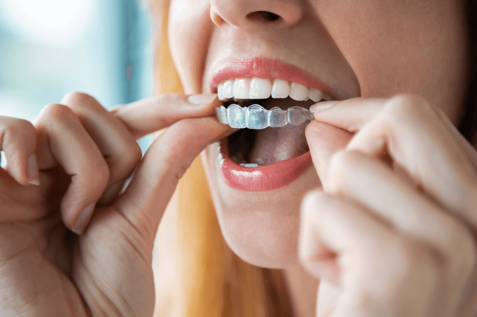 Woman putting Invisalign clear braces in her mouth in Marylebone