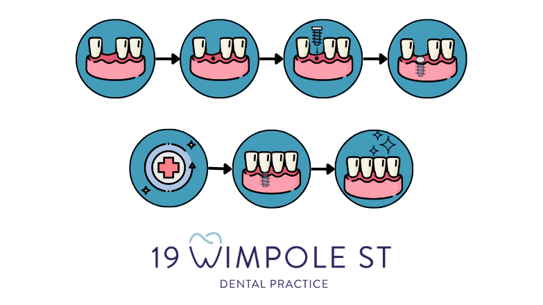 graphics showcasing the dental implant process at 19 Wimpole Street, Marylebone
