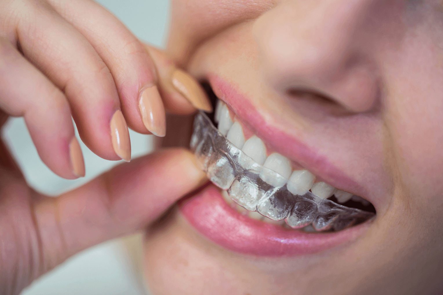 woman placing invisalign clear brace into her mouth at our Marylebone dental practice