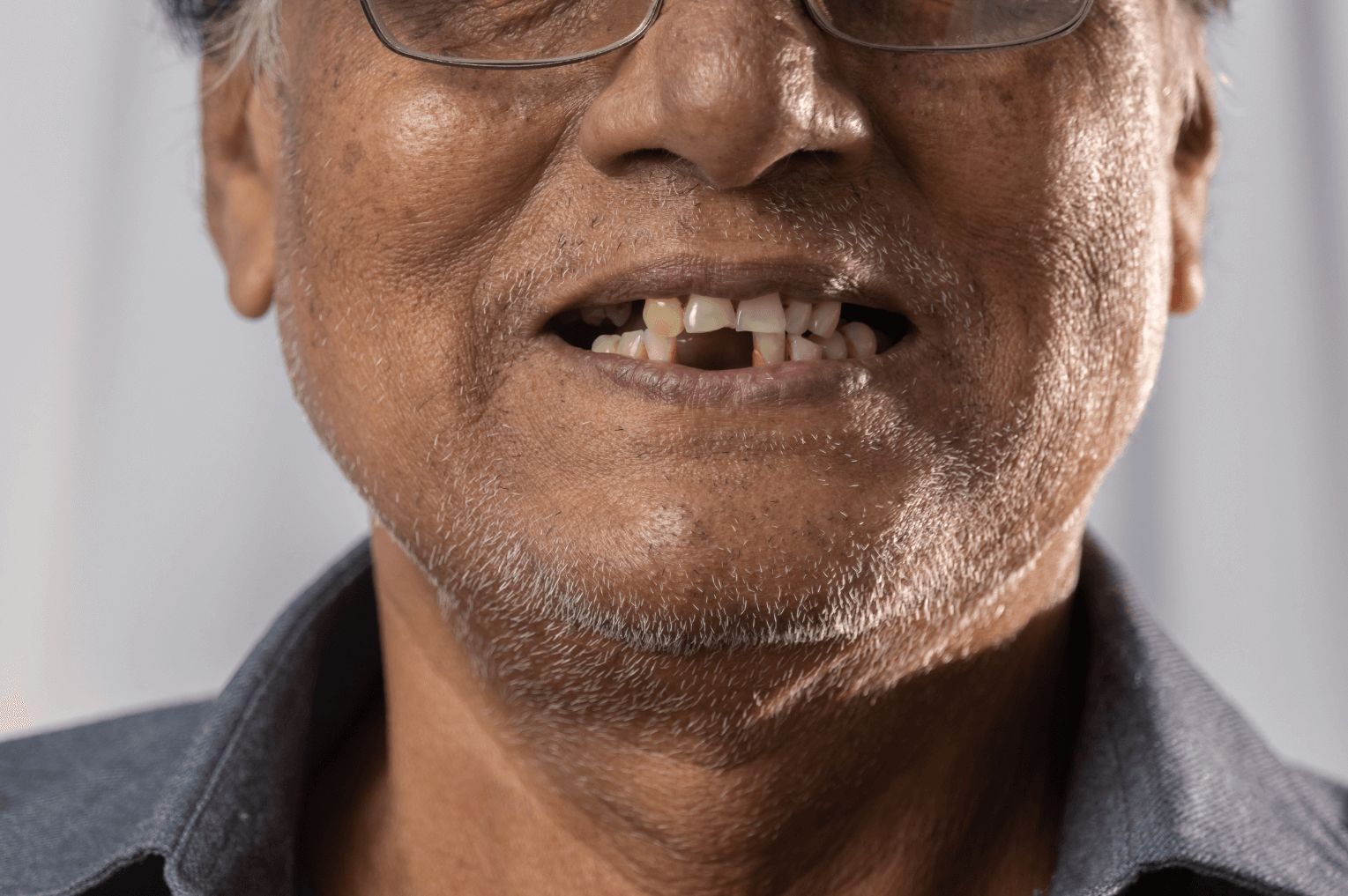 Man with missing teeth in London