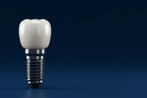 Image of dental implants at 19 wimpole street.