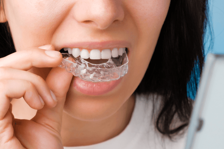 woman putting invisalign retainer in after starting treatment with 19 Wimpole Street
