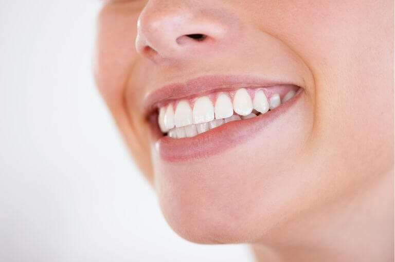 Woman smiling with composite bonding on her teeth