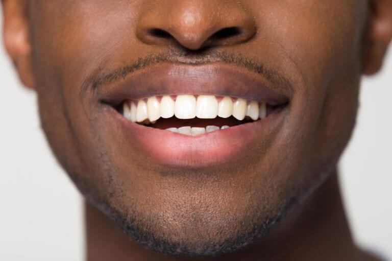 Man smiling with composite bonding